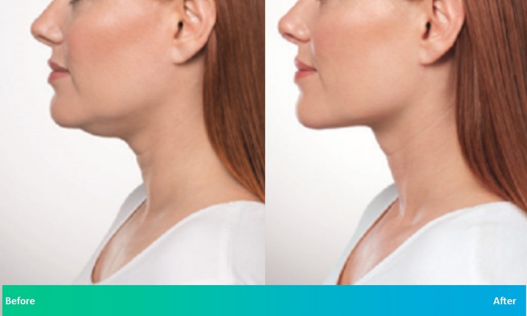 Kybella Before & After in Delray Beach